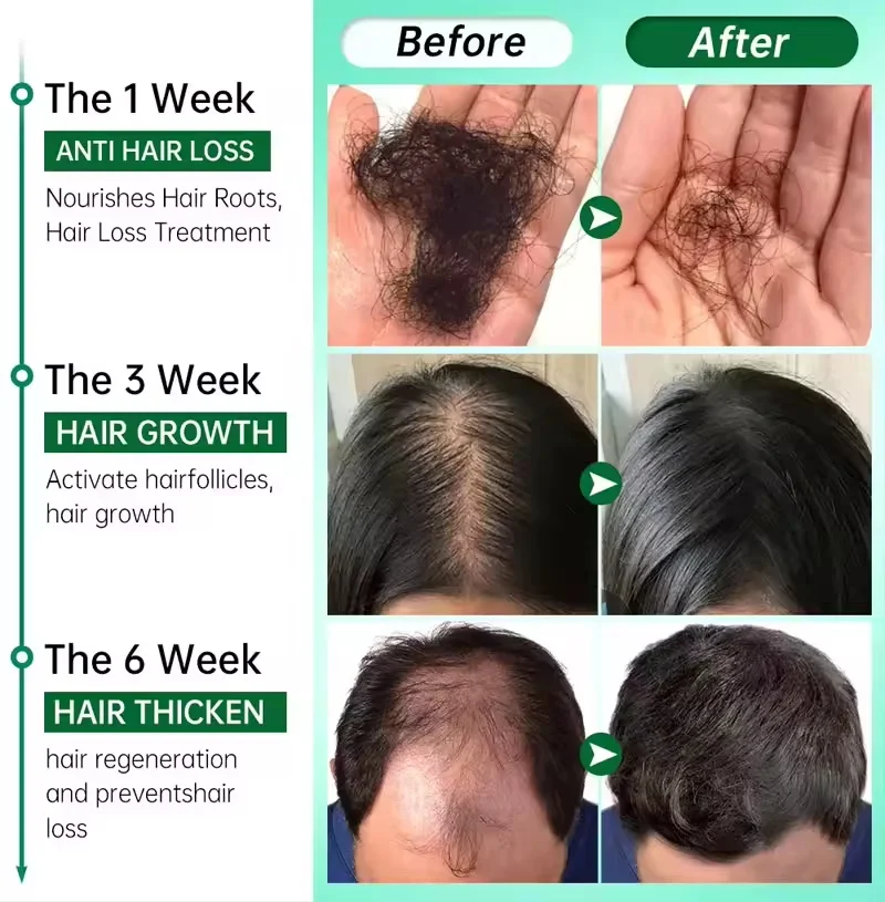 Hair Growth Products Anti Hair Loss Essential Oil Prevent Baldness Scalp Treatment Capsule Fast Regrowth Beauty Health Men Women - Image 5